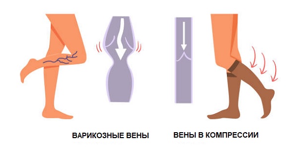 Механизм действия компрессионного трикотажа при варикозном расширении вен