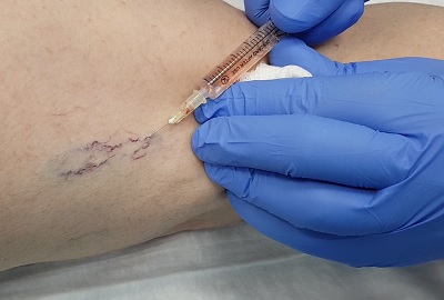 Удаление сосудистых звездочек методом микросклеротерапии