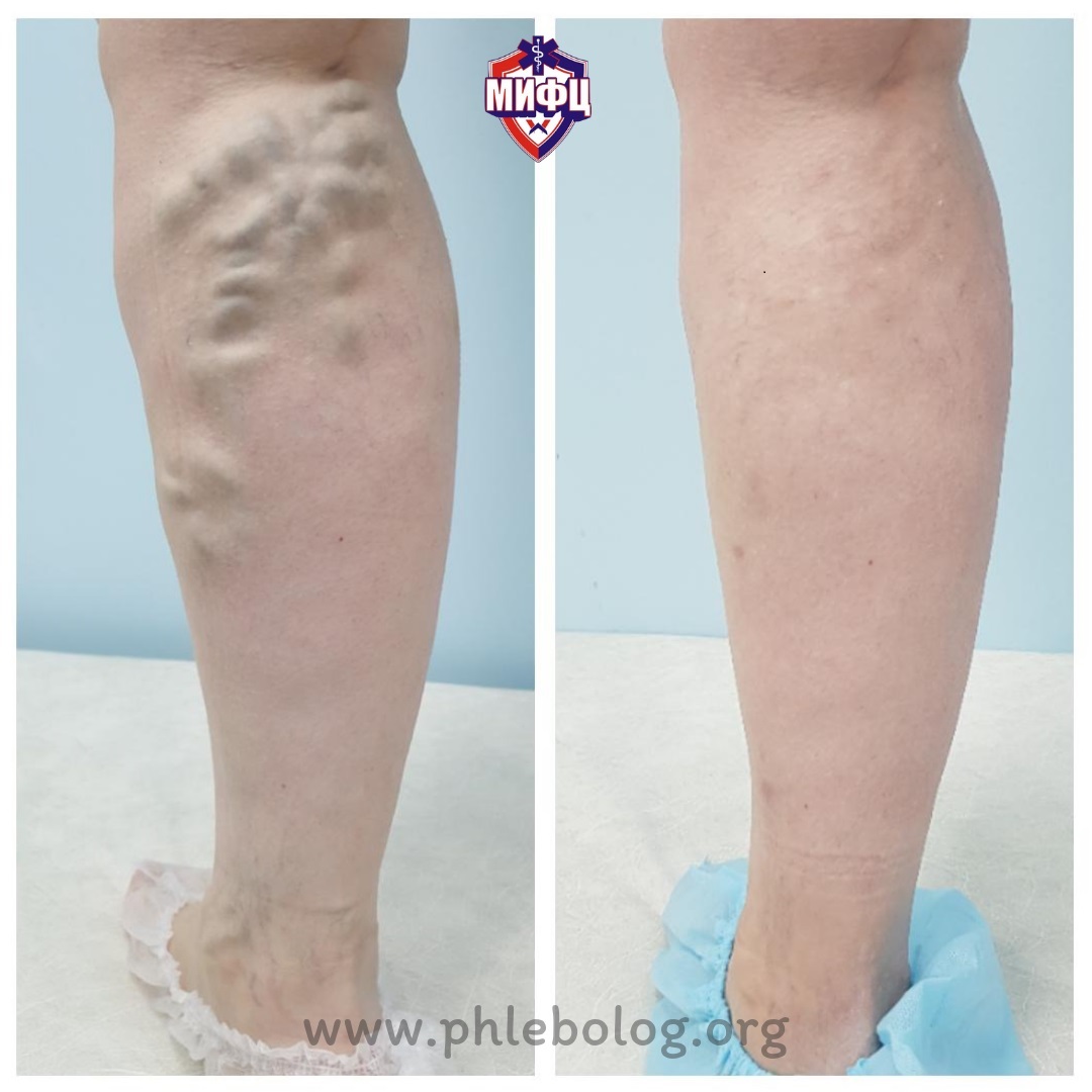 Результат лечения варикоза через 6 месяцев в нашей клинике