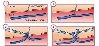 Этапы проведения минифлебэктомии по Варади