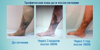Лечение трофической язвы лазером