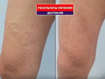 Когда никто не верит, что была операция. Результат Тотал ЭВЛК через 2 года