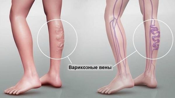 РЧА - радиочастотная абляция при варикозной болезни нижних конечностей
