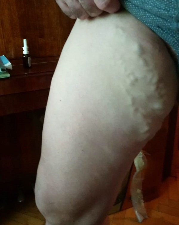 Рецидив варикозной болезни. Причины, лечение и профилактика рецидива варикозной болезни нижних конечностей