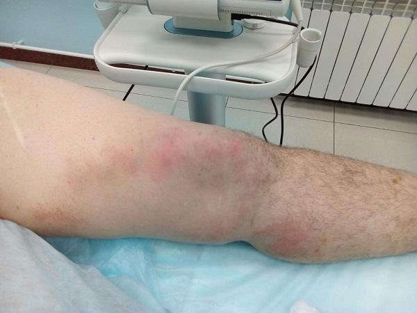 лечение тромбофлебита лазером