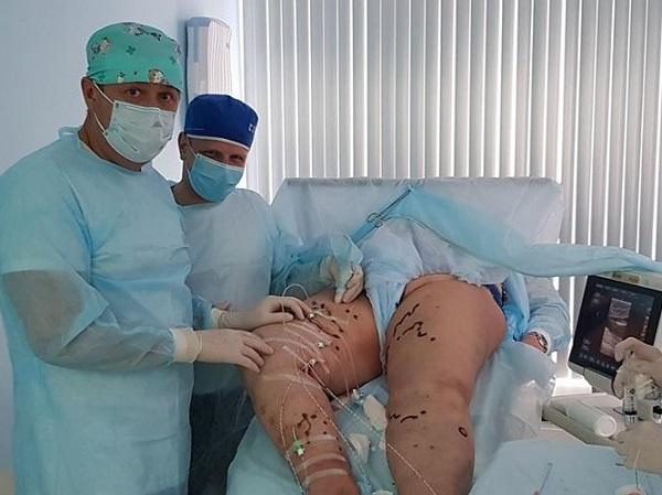 Сложный случай - ЭВЛК после перенесенного тромбофлебита: проведено несколько световодов