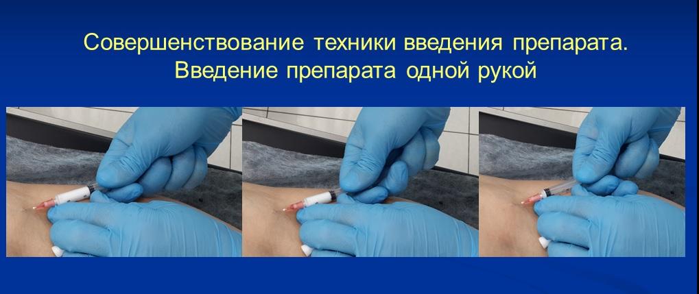 Введение склерозанта в расширенную вену на руке