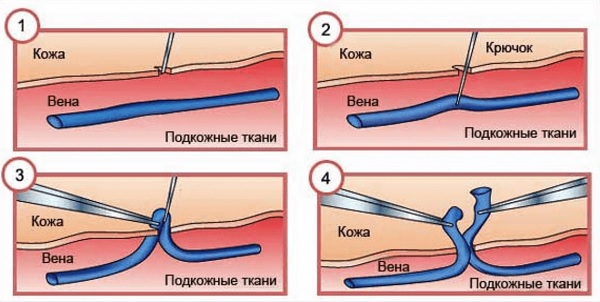 Минифлебэктомия – удаление варикозных вен крючками (выдергивание вен)
