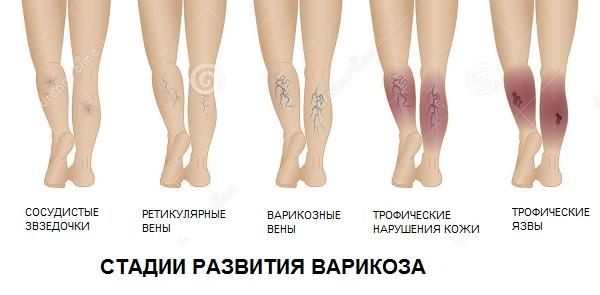 Стадии варикоза вен нижних конечностей