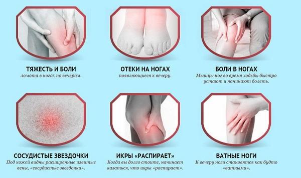 Симптомы варикозной болезни