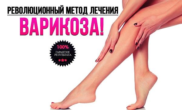Лечение варикозной болезни без операции
