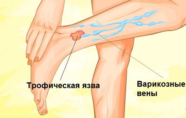 Трофическая язва на ноге