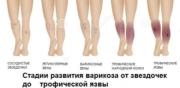 Стадии развития трофической язвы на ногах