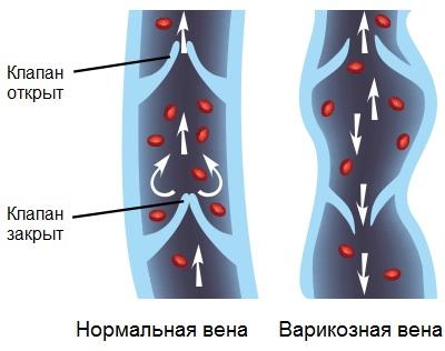 венозные клапаны на ногах