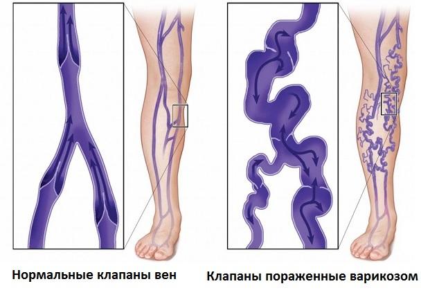 Венозные клапаны